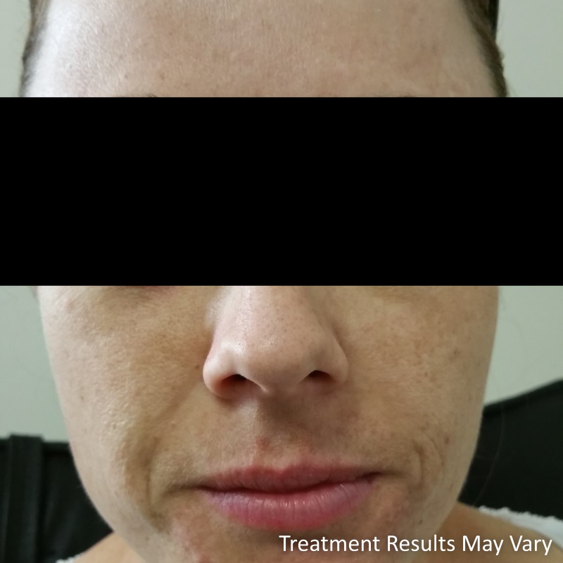 During pregnancy Abbie noted her face was becoming pigmented. This is called “Melasma” and often starts with pregnancy hormones and exposure to light.