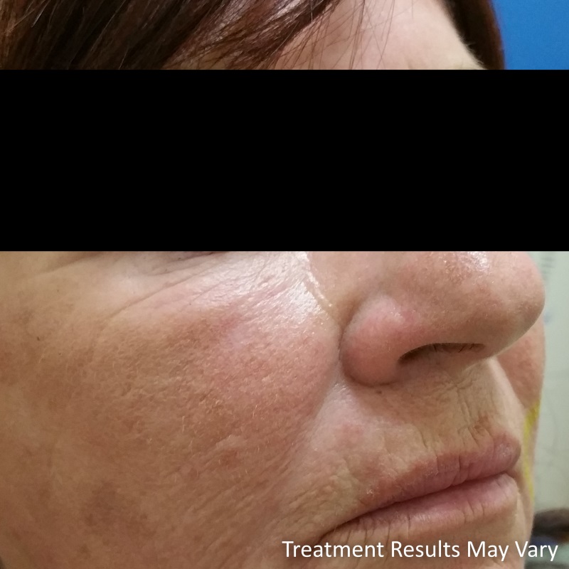Audrey is in the 60’s and still working. Although she accepts lines and wrinkles as part of her ageing she desired to look better. Audrey had a 12 week treatment package to improve her appearance and give her a lift... now she feels great!