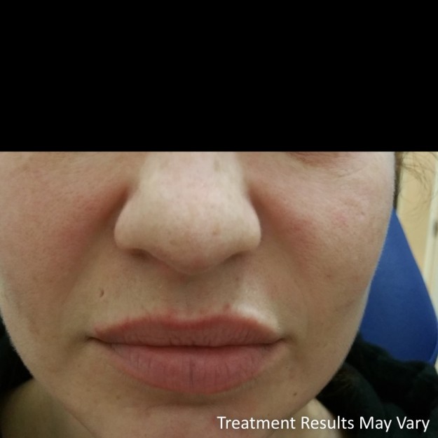 beautify-success-story-angelas-natural-lips-1