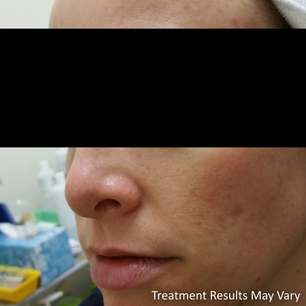 beautify-sa-cassie-acne-scar-reduction-1