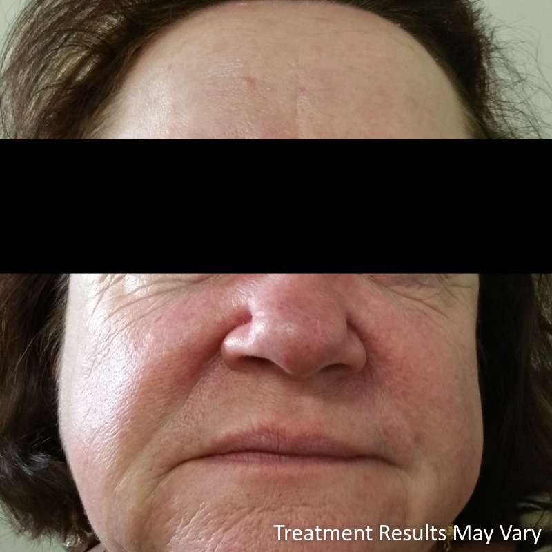 Carol is in her early 60’s and is retired from work but not from life. Carol is energetic, fit and well.  She felt her external looks did not reflect her zest for life and her internal youth.  Concerning her mostly was the rosacea (red flushed appearance) on her nose and cheeks.