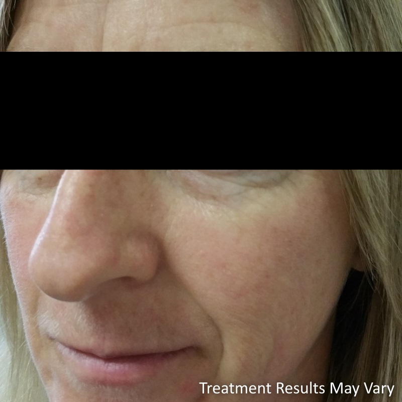 Anna is in her late 40’s and has 4 active daughters, Anna’s confidence had hit rock bottom due to personal issues and felt she was prematurely ageing.  Anna had lost a lot of volume in her face which happens with ageing and stress. Over a period of 6 months Anna had non-permanent fillers in her cheeks and other areas in her face to restore a more youthful appearance.