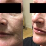 lip-filler-treatment-before-after-beautify-sa