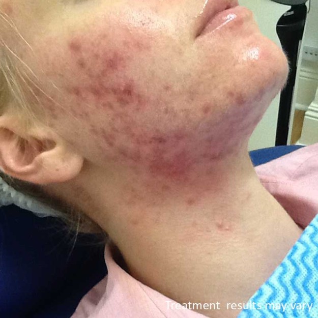 Beautify Acne Treatments by Lucy